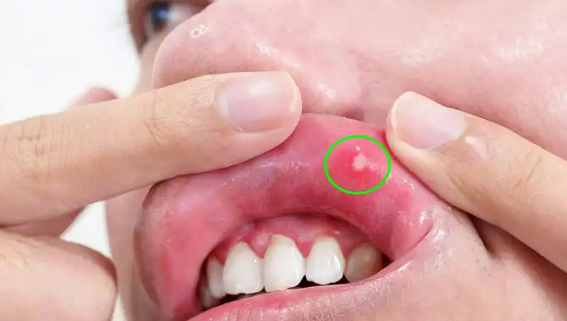 Kanserin Sessiz Uyarısı: Dil Alımının Gerekliliği ve Belirtiler